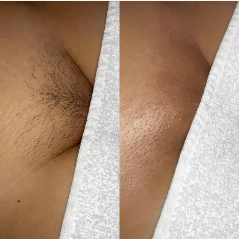 brazilian wax before and after