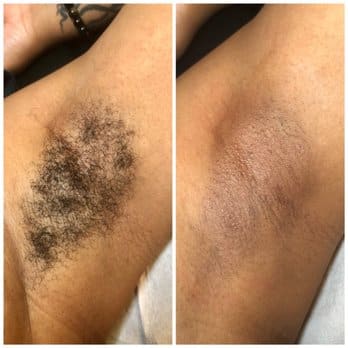underarm wax before and after